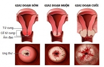 Viêm lộ tuyến cổ tử cung là gì ?