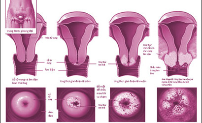 Hình ảnh sa tử cung ở nữ 2